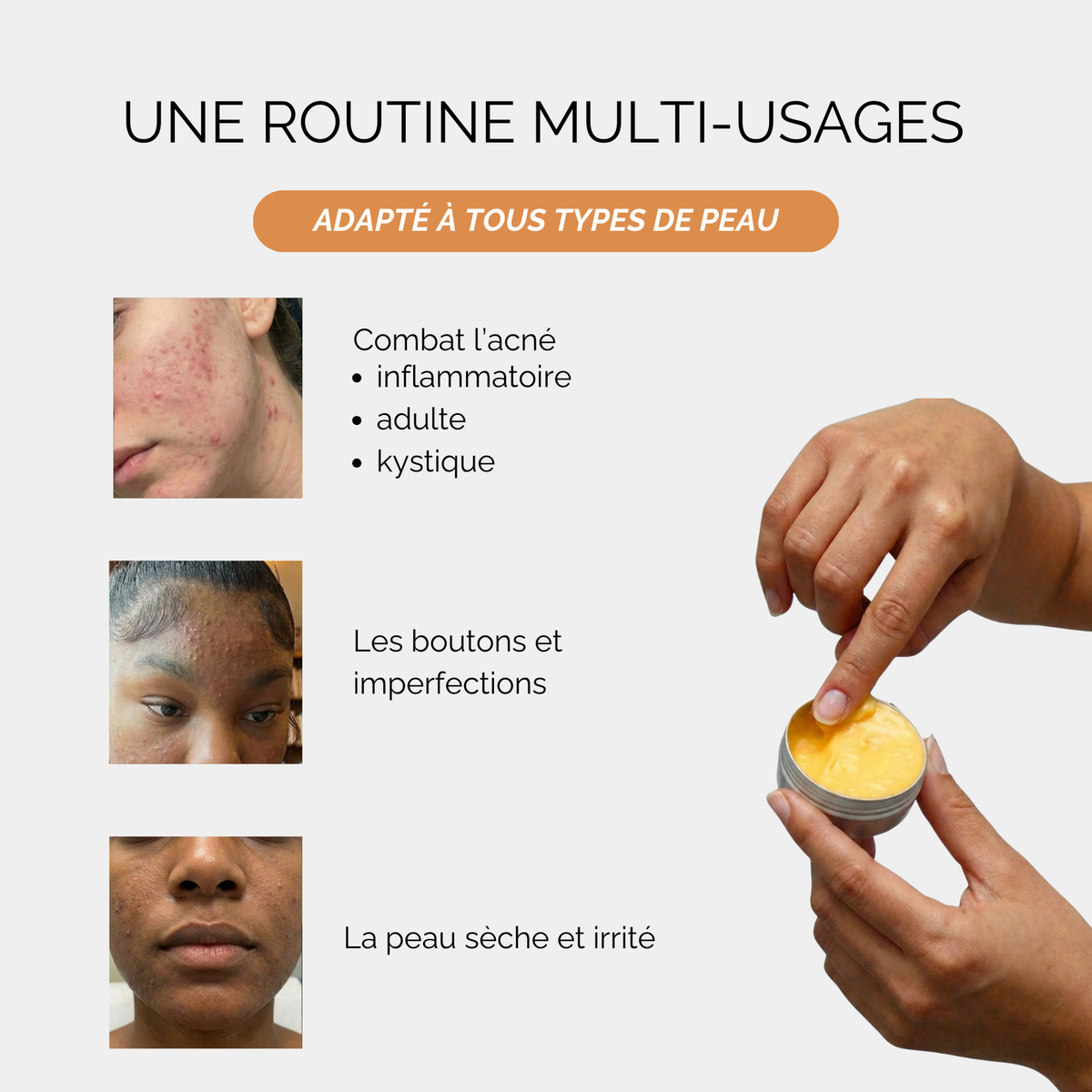 Baumes Apaisants Anti-Acné
